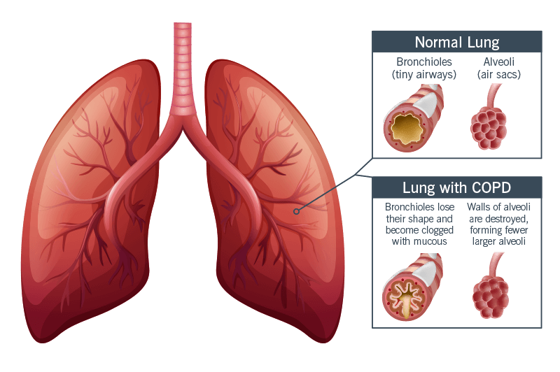 COPD Causes & Symptoms Chronic Obstructive Pulmonary Disorder